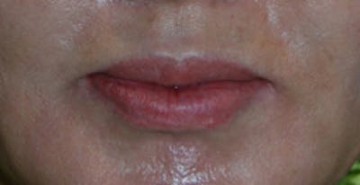 Lip Augmentation Before & After Gallery - Patient 288942 - Image 2