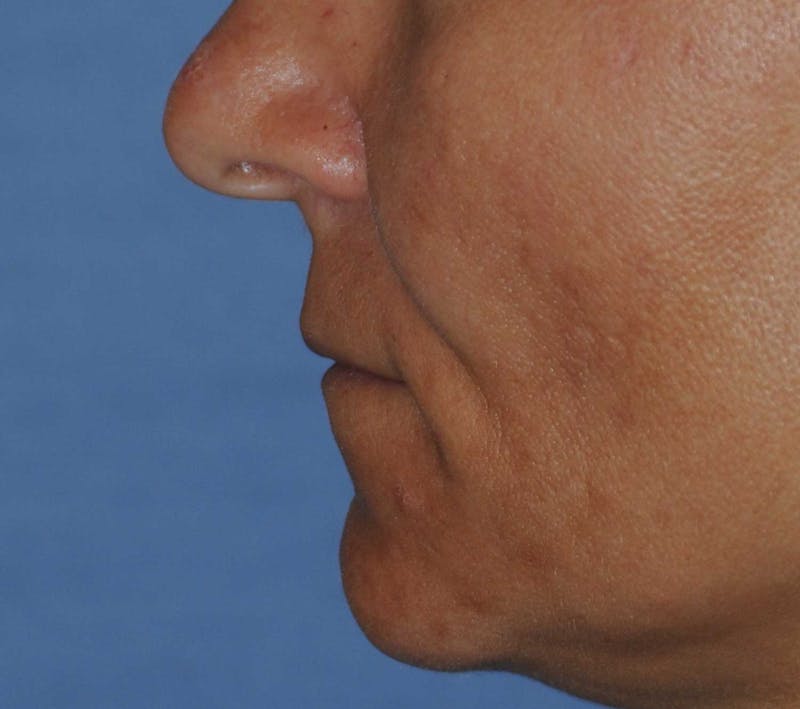 Lip Augmentation Before & After Gallery - Patient 208220 - Image 3