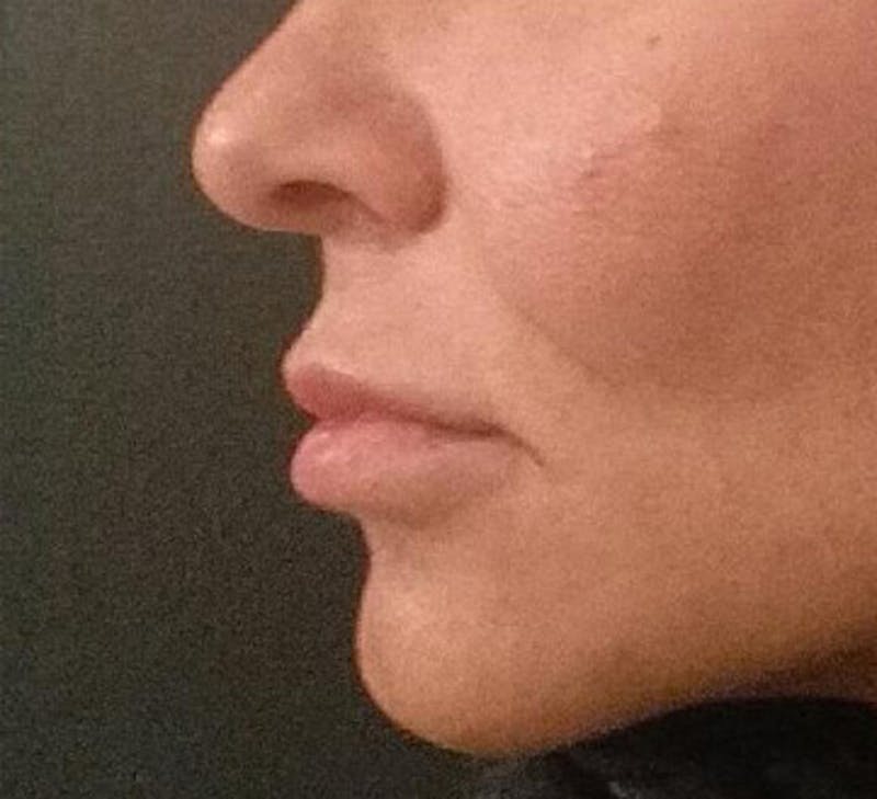 Lip Augmentation Before & After Gallery - Patient 208220 - Image 4
