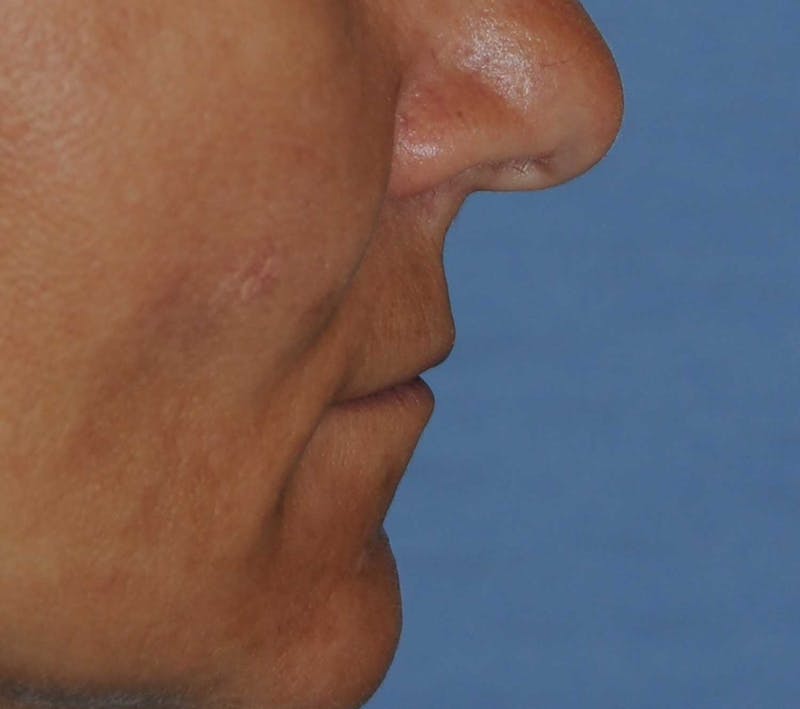 Lip Augmentation Before & After Gallery - Patient 208220 - Image 5