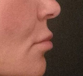 Lip Augmentation Before & After Gallery - Patient 208220 - Image 6