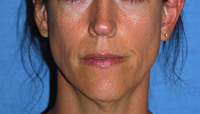 Lip Augmentation Before & After Gallery - Patient 111028 - Image 1