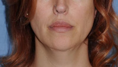 Lip Augmentation Before & After Gallery - Patient 111028 - Image 2