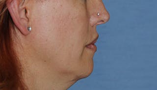 Lip Augmentation Before & After Gallery - Patient 111028 - Image 4