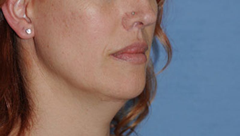 Lip Augmentation Before & After Gallery - Patient 111028 - Image 6