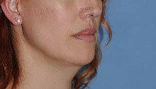 Lip Augmentation Before & After Gallery - Patient 111028 - Image 6