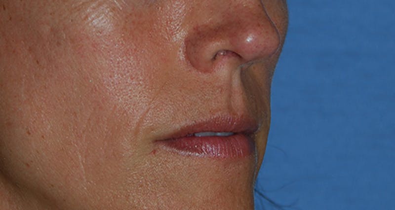 Lip Augmentation Before & After Gallery - Patient 111028 - Image 7