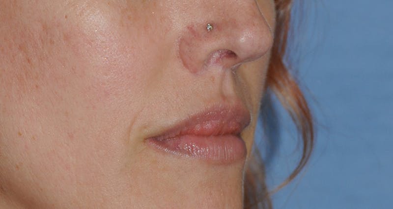 Lip Augmentation Before & After Gallery - Patient 111028 - Image 8