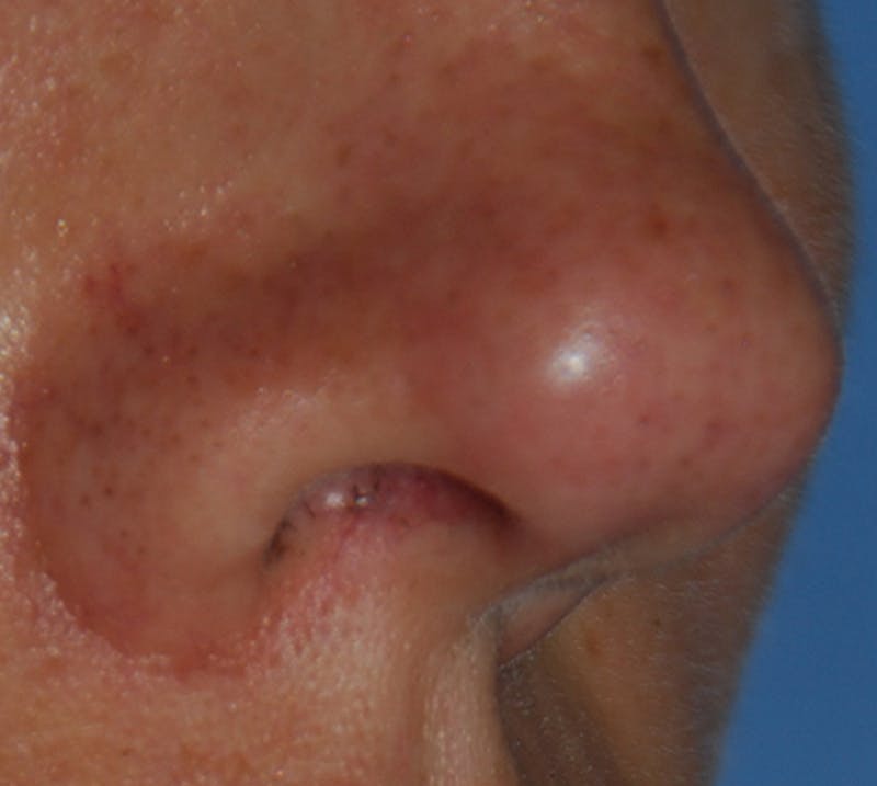 Lip Augmentation Before & After Gallery - Patient 111028 - Image 9