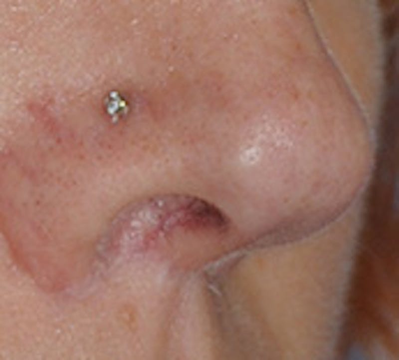 Lip Augmentation Before & After Gallery - Patient 111028 - Image 10