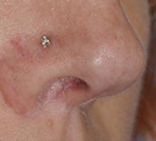 Lip Augmentation Before & After Gallery - Patient 111028 - Image 10