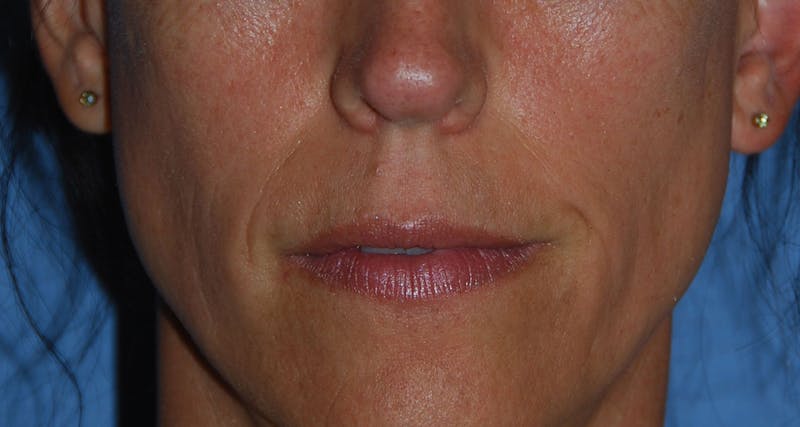 Lip Augmentation Before & After Gallery - Patient 111028 - Image 11