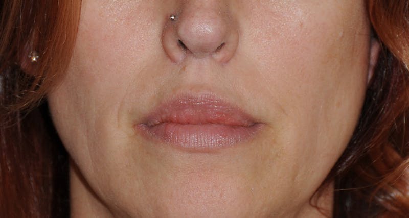 Lip Augmentation Before & After Gallery - Patient 111028 - Image 12