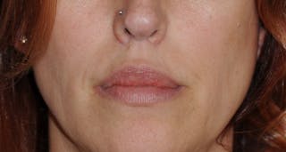 Lip Augmentation Before & After Gallery - Patient 111028 - Image 12