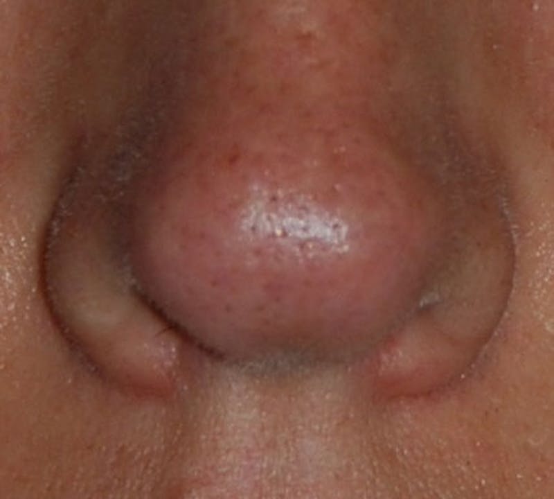 Lip Augmentation Before & After Gallery - Patient 111028 - Image 13