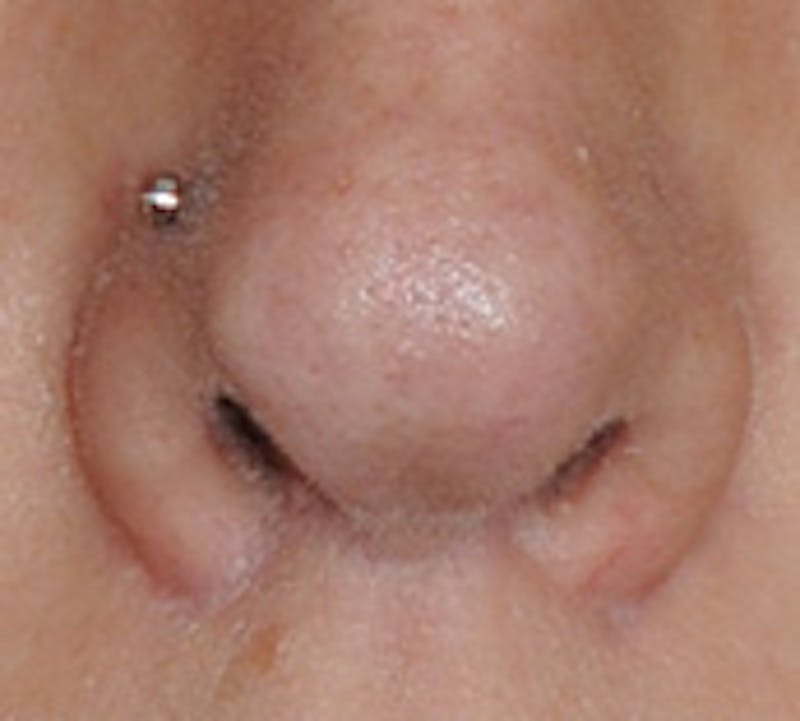 Lip Augmentation Before & After Gallery - Patient 111028 - Image 14