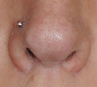 Lip Augmentation Before & After Gallery - Patient 111028 - Image 14