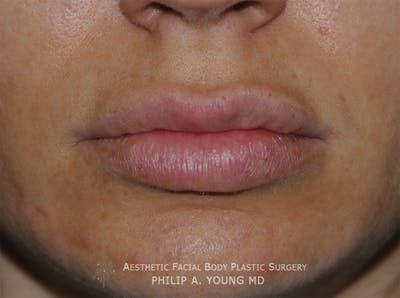 Lip Augmentation Before & After Gallery - Patient 205200 - Image 1