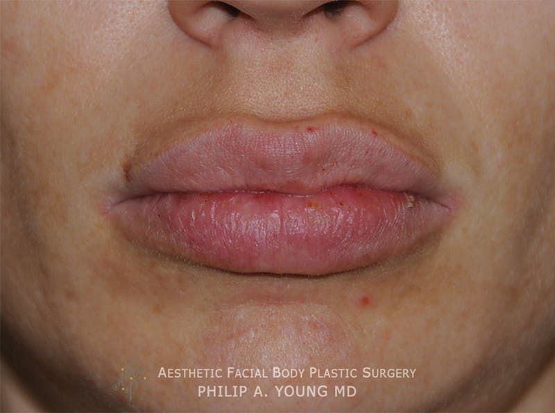 Lip Augmentation Before & After Gallery - Patient 205200 - Image 2