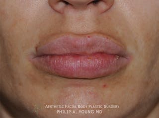 Lip Augmentation Before & After Gallery - Patient 205200 - Image 2