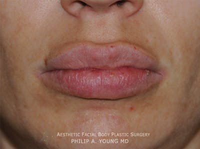 Lip Augmentation Before & After Gallery - Patient 205200 - Image 2