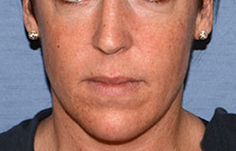 Lip Augmentation Before & After Gallery - Patient 546374 - Image 1