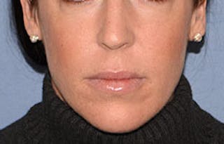 Lip Augmentation Before & After Gallery - Patient 546374 - Image 2