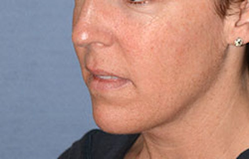 Lip Augmentation Before & After Gallery - Patient 546374 - Image 3