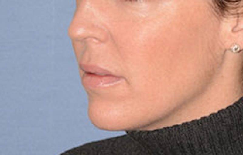 Lip Augmentation Before & After Gallery - Patient 546374 - Image 4