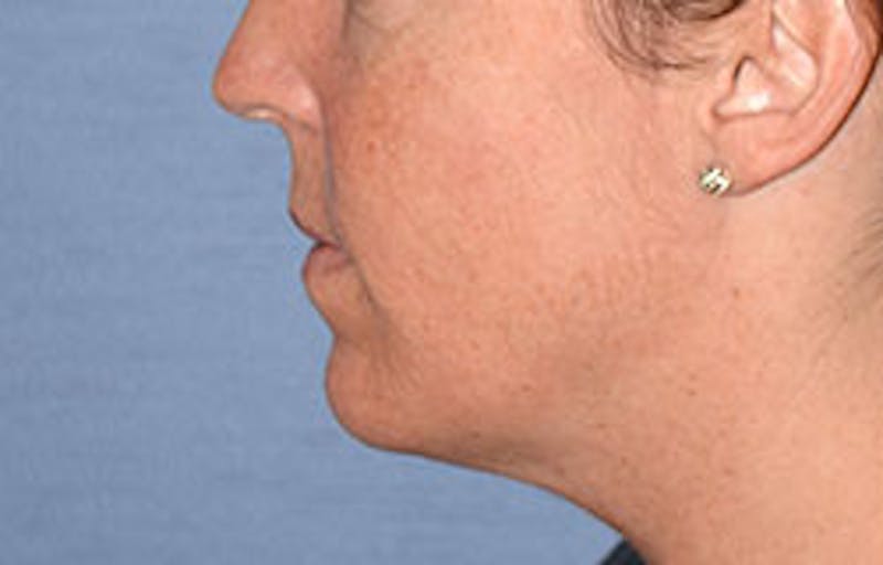 Lip Augmentation Before & After Gallery - Patient 546374 - Image 5
