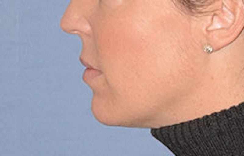 Lip Augmentation Before & After Gallery - Patient 546374 - Image 6