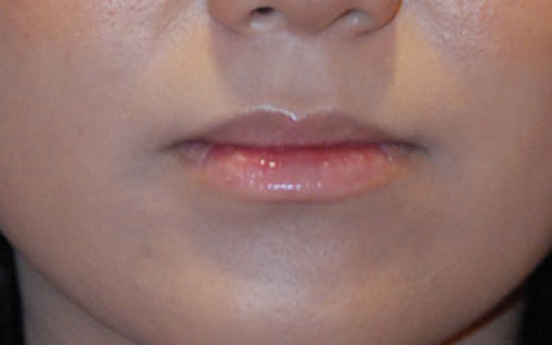 Lip Augmentation Before & After Gallery - Patient 306532 - Image 1