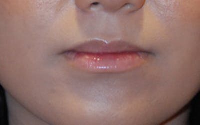 Lip Augmentation Before & After Gallery - Patient 306532 - Image 1