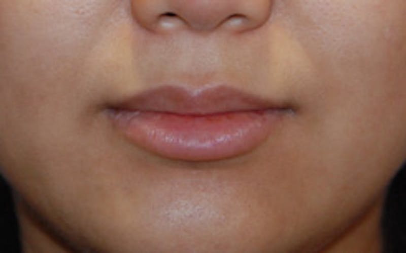 Lip Augmentation Before & After Gallery - Patient 306532 - Image 2