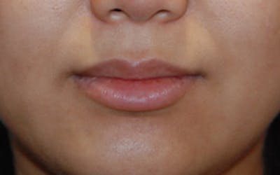 Lip Augmentation Before & After Gallery - Patient 306532 - Image 2