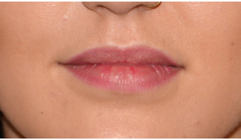 Lip Augmentation Before & After Gallery - Patient 617277 - Image 1
