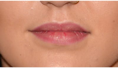 Lip Augmentation Before & After Gallery - Patient 617277 - Image 1