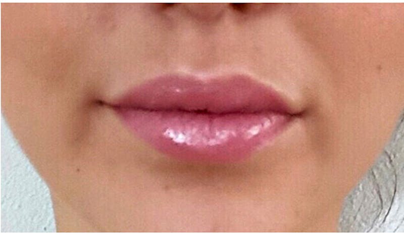 Lip Augmentation Before & After Gallery - Patient 617277 - Image 2