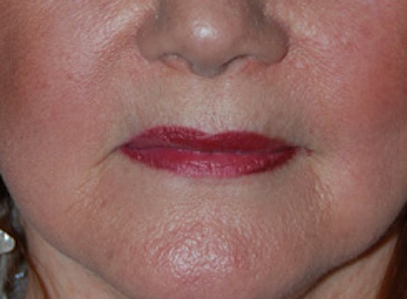 Lip Augmentation Before & After Gallery - Patient 407386 - Image 1