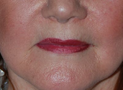 Lip Augmentation Before & After Gallery - Patient 407386 - Image 1