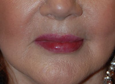 Lip Augmentation Before & After Gallery - Patient 407386 - Image 2