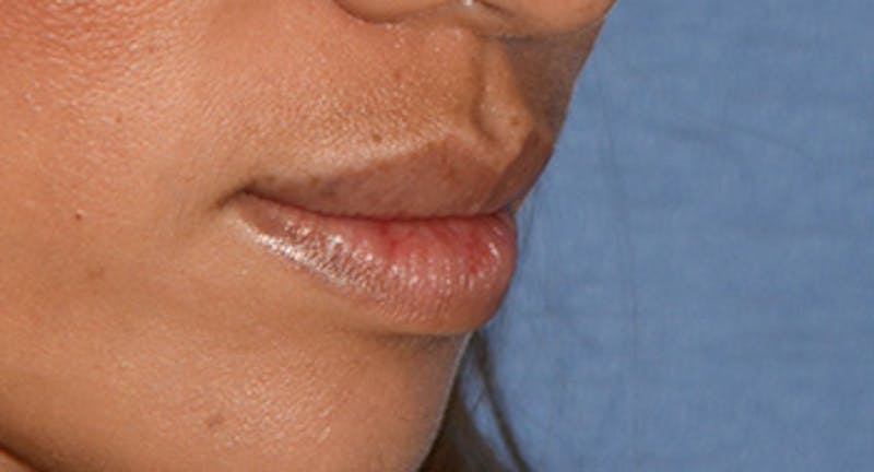 Lip Augmentation Before & After Gallery - Patient 122863 - Image 1