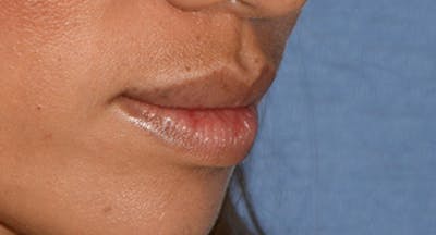 Lip Augmentation Before & After Gallery - Patient 122863 - Image 1