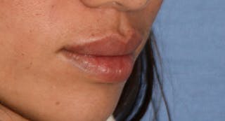 Lip Augmentation Before & After Gallery - Patient 122863 - Image 2