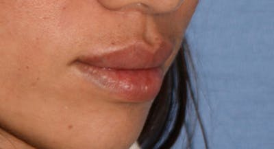 Lip Augmentation Before & After Gallery - Patient 122863 - Image 2