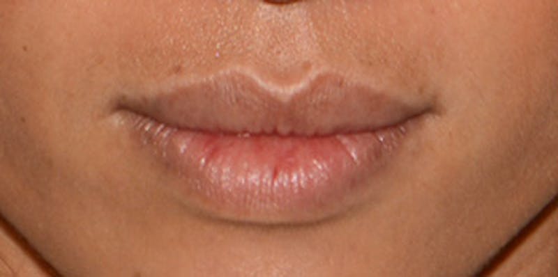 Lip Augmentation Before & After Gallery - Patient 122863 - Image 3