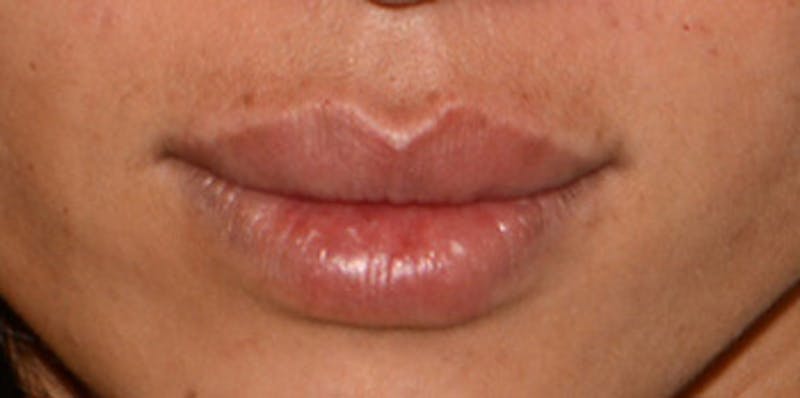 Lip Augmentation Before & After Gallery - Patient 122863 - Image 4