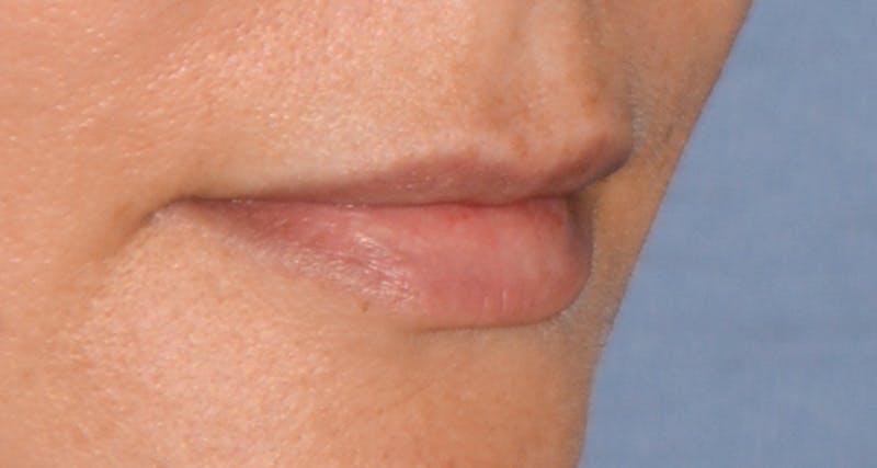 Lip Augmentation Before & After Gallery - Patient 207174 - Image 1