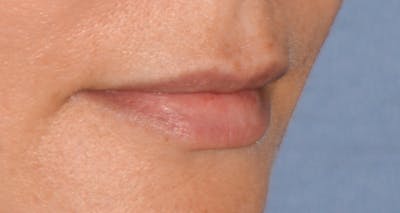 Lip Augmentation Before & After Gallery - Patient 207174 - Image 1