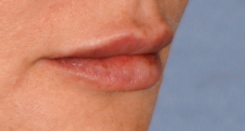 Lip Augmentation Before & After Gallery - Patient 207174 - Image 2